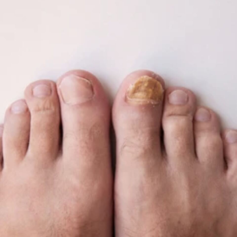 Fungal Toenails