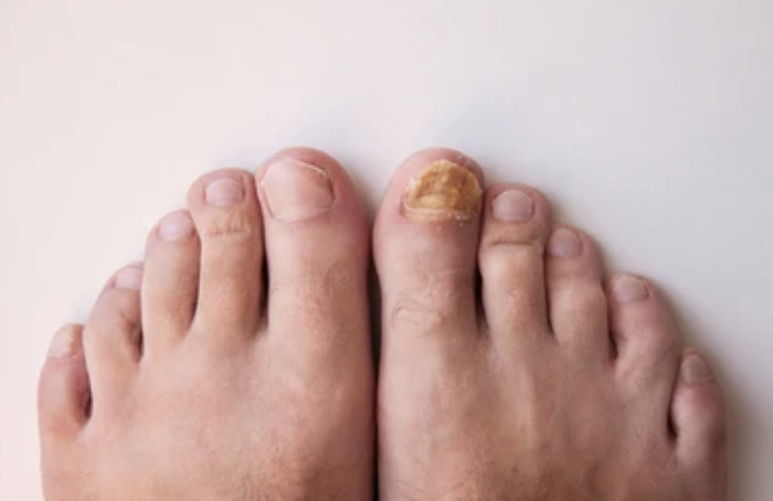 Fungal Toenails: Why Over-the-Counter Treatments Often Fail - and What Actually Works