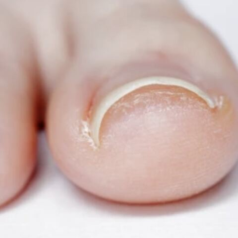 Ingrown Toenails: When to Treat at Home - and When to See a Doctor