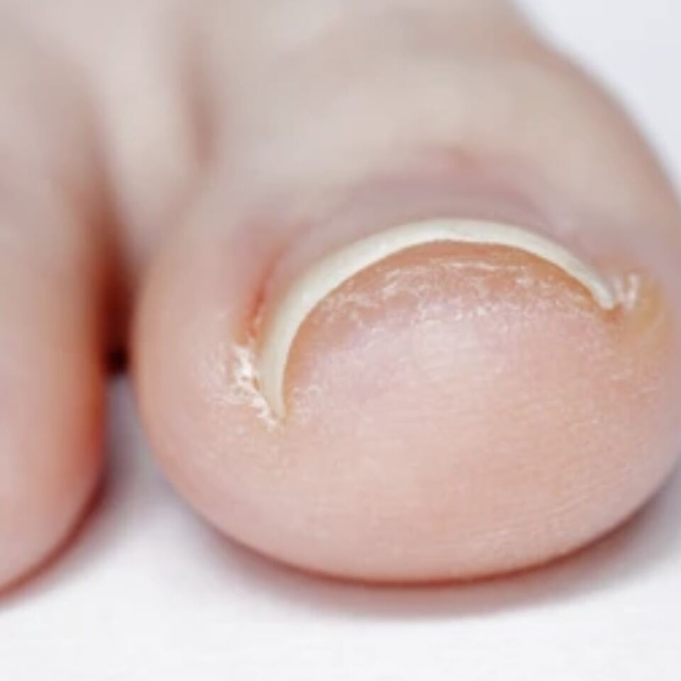 Ingrown Toenails