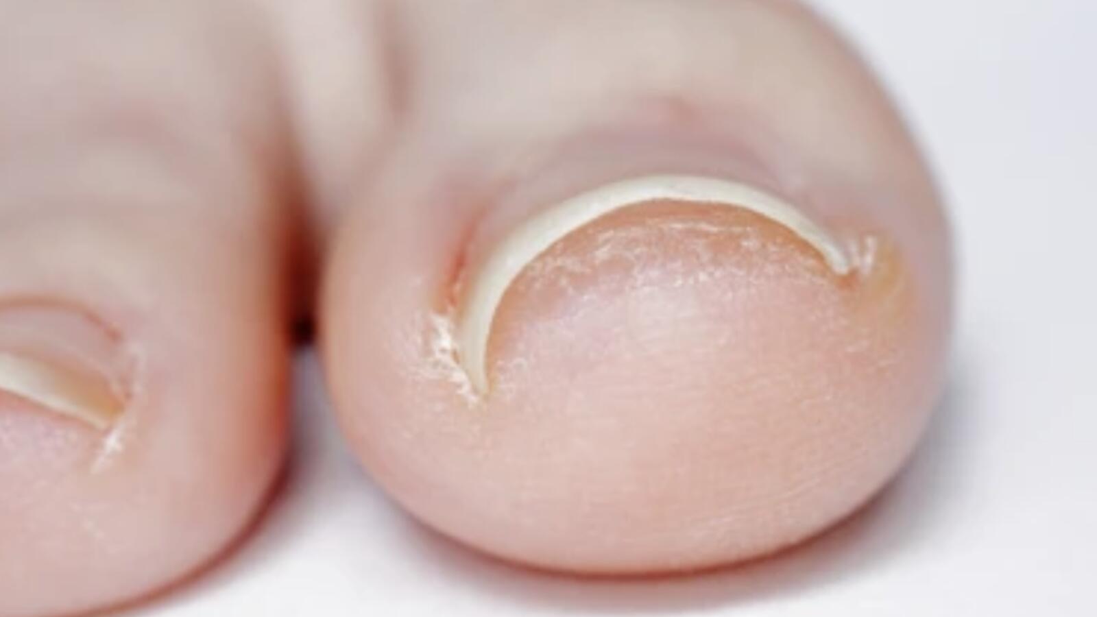 Ingrown Toenails