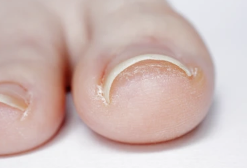 Ingrown Toenails: When to Treat at Home - and When to See a Doctor