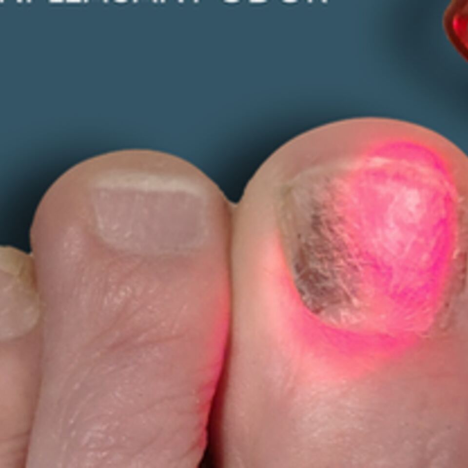 Class IV Laser Treatment for Toenail Fungus: What Columbus Patients Need to Know