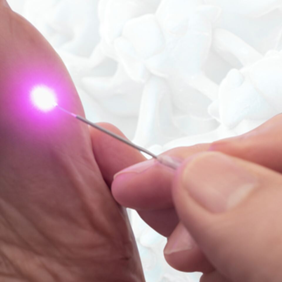 Laser Treatment for Plantar Warts: Fast, Drug-Free, and No Anesthetic Required