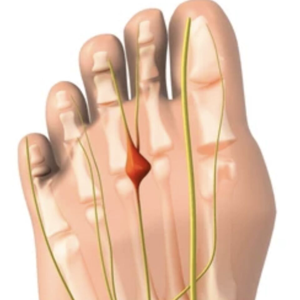 Neuromas (Morton's Neuroma)