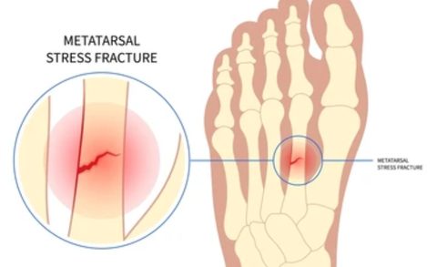 Foot Stress Fracture vs. Sprain: How to Tell the Difference (and Why It Matters)