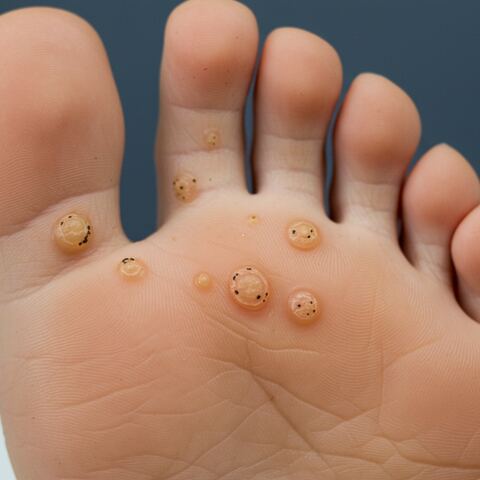 Plantar Warts: How Contagious Are They Really?
