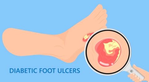 Preventing Diabetic Foot Ulcers: What Every Person with Diabetes Must Know